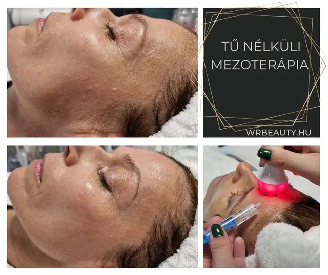 Tű nélküli mezoterápia: mit takar az elnevezés? – 2. kép