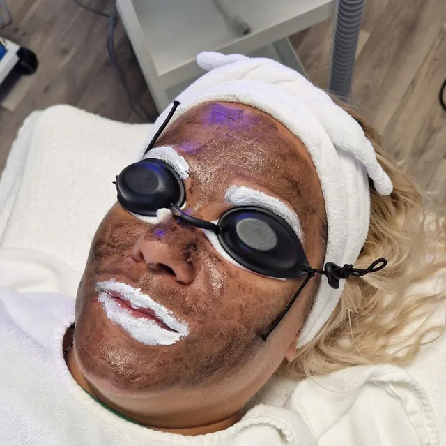 Carbon Peeling: mit kérdezz meg foglalás előtt? – 2. kép